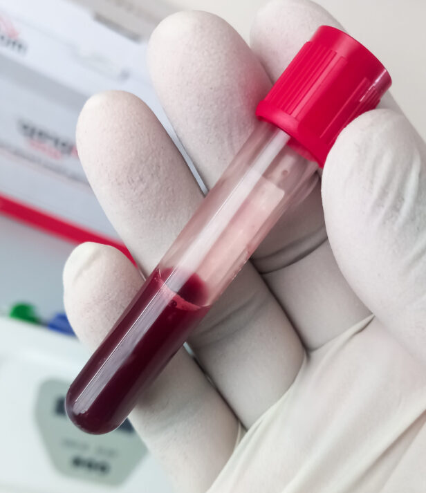 Hand of a doctor holding a test tube of blood. close up view.